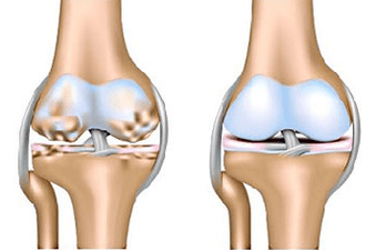 Healthy and arthritis union