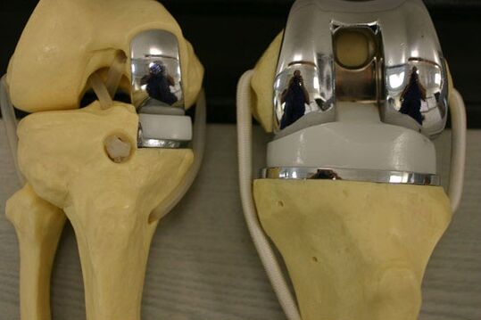 Variants of knee node endoprosthetics