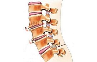 spondillartrosis as causes of back pain