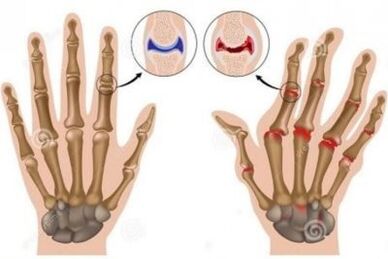 Causes of pain in finger joints