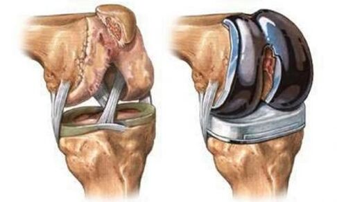 Knee joint endoprostetics for arthrosis