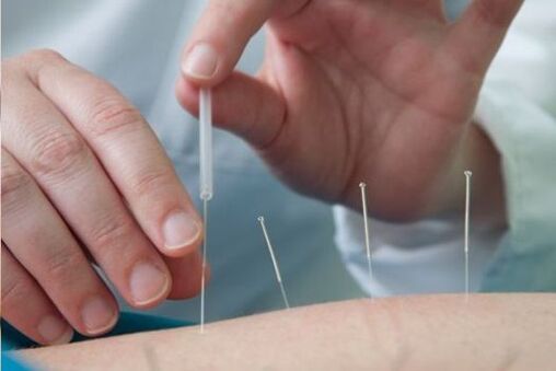 Acupuncture is a method for treating pain in the lumbar region caused by osteochondrosis