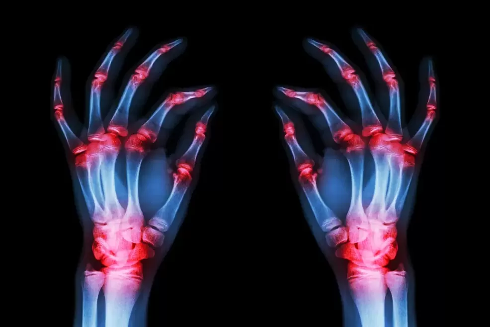 arthrosis of the finger joints