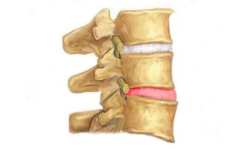 Prolongation of the intervertebral disc of the spine - a sign of osteochondrosis