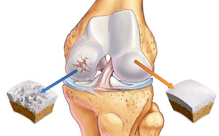 Healthy knee joint (right) and affected by osteoarthritis (left)