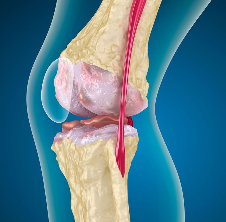 Osteoarthritis of the knee joint - a degenerative-dystrophic disease